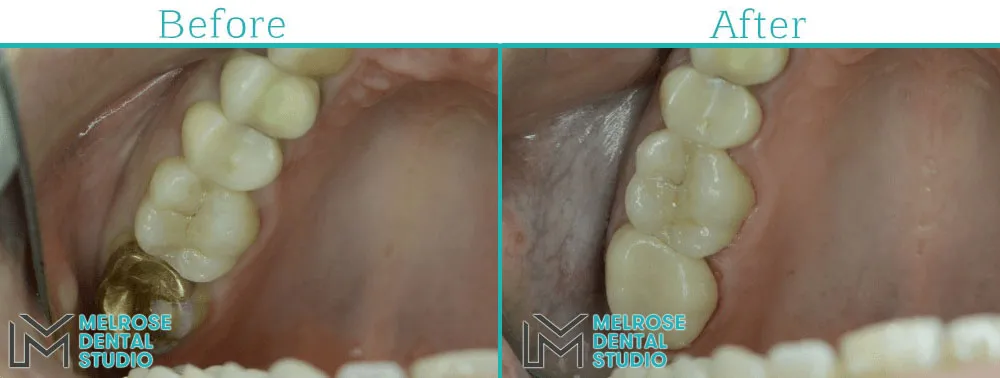 Before and after of a same-day CEREC ceramic crown at Melrose Dental Studio, case 1