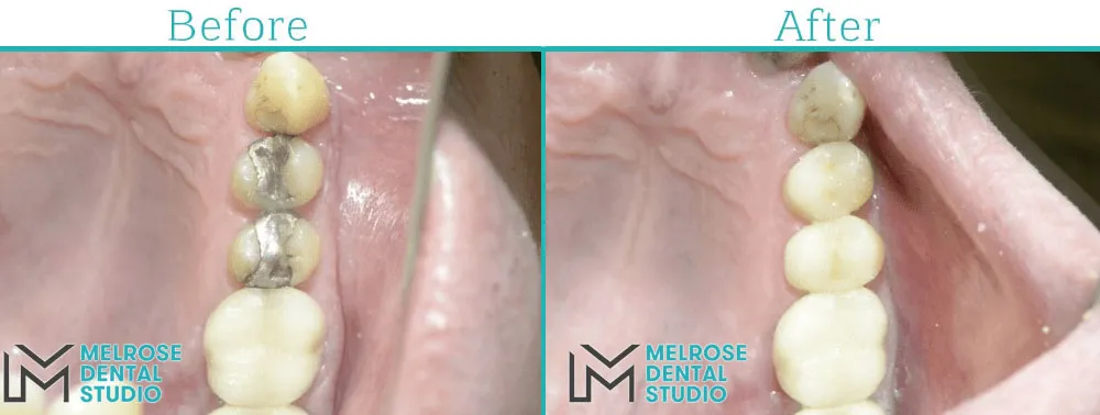 Before and after of a same-day CEREC ceramic crown at Melrose Dental Studio, case 2