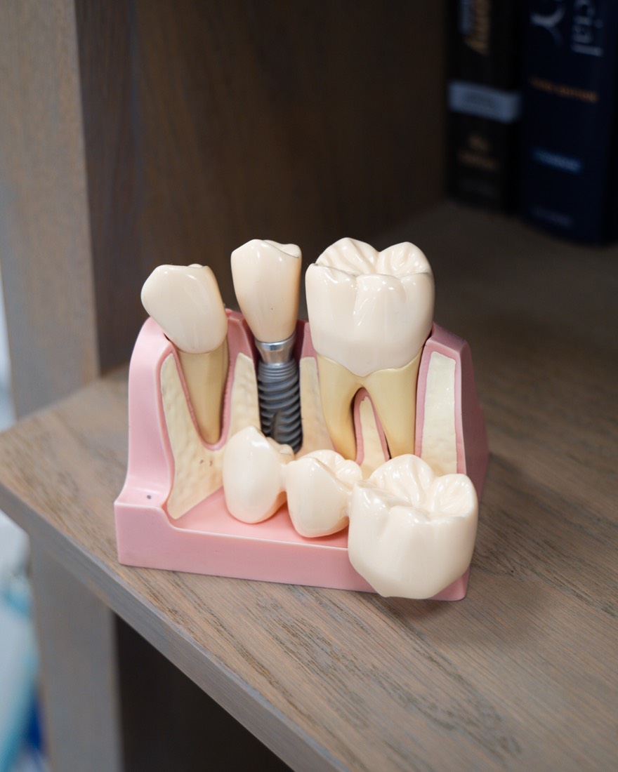 Dental implant model showing the titanium root and crown