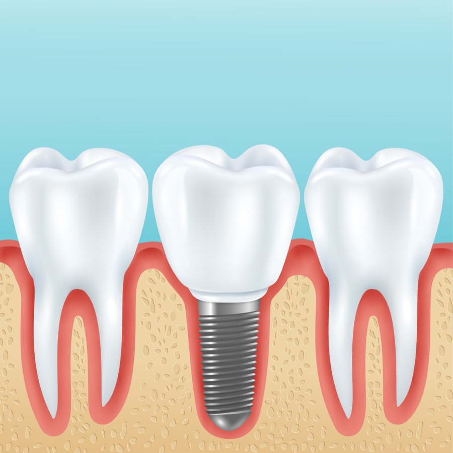 Dental implant model showing titanium implant and crown